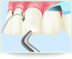 STEP2 歯と歯の間のクリーニング