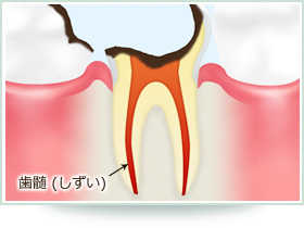 歯髄炎の症状