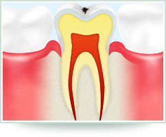 【CO　初期虫歯】