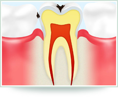 【C1　エナメル質の虫歯】