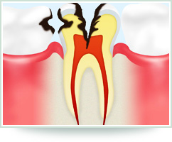 【C2　象牙質の虫歯】