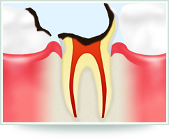 【C3　神経に達した虫歯】