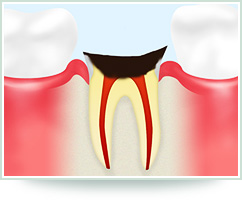 【C4　歯根に達した虫歯】