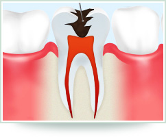 重度の虫歯でも諦めないで！～根管治療～