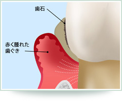 中度歯周炎