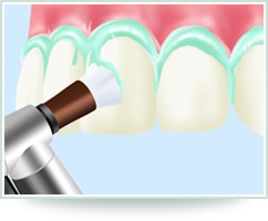 STEP3 歯と歯ぐきの間、歯の表面のクリーニング