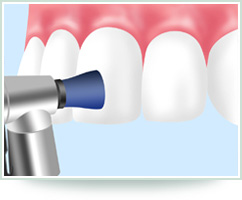 STEP4 研磨剤の洗浄、フッ素ジェルの塗布